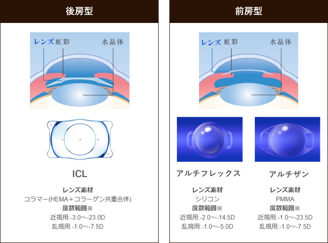 ICL手術（眼内コンタクトレンズ）｜大阪のむさしドリーム眼科