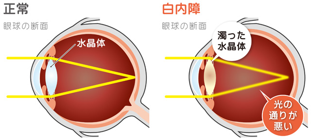 老眼と白内障の違いについて