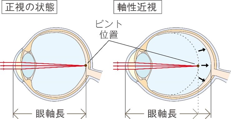 近視とは