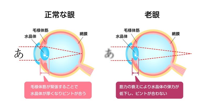 老眼（老視）とは